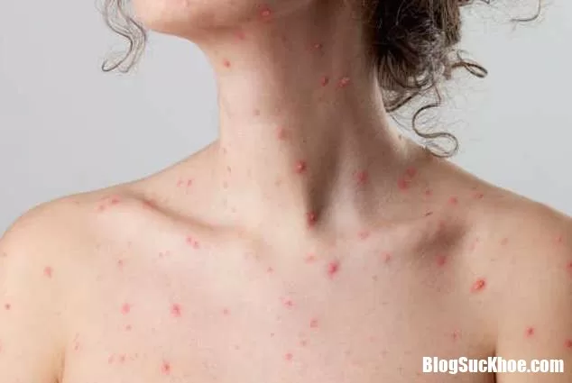 Cách chăm sóc người bệnh thủy đậu giúp nhanh phục hồi sức khỏe
