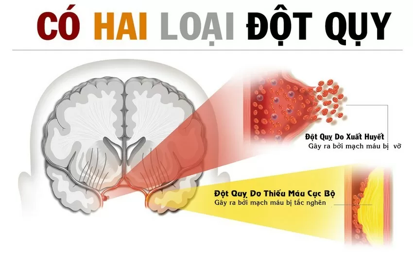 Nhận biết và sơ cứu người đột quỵ kịp thời giúp giảm được 50% nguy cơ tử vong