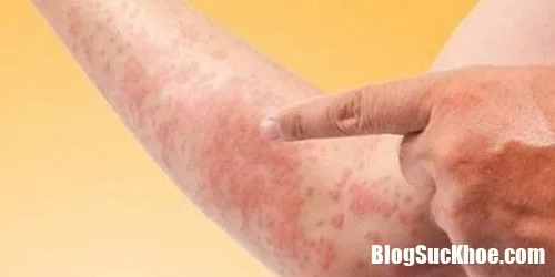 Cách trị dứt điểm dị ứng bằng bài thuốc dân gian