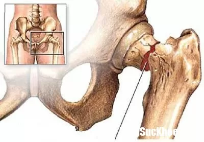 Phương pháp chữa trị loãng xương hiệu quả cho người già