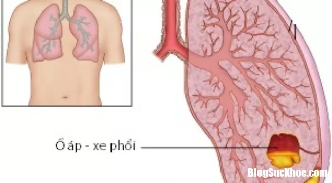 Nguyên nhân và cách chữa trị bệnh áp xe phổi hiệu quả