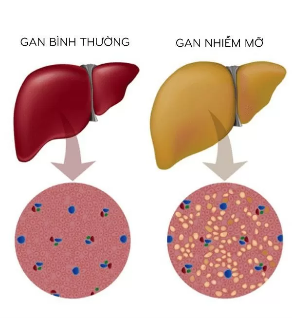 Chớ nên chủ quan coi thường gan nhiễm mỡ độ 1