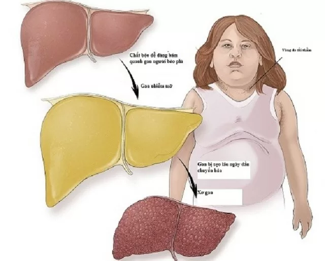 Dân văn phòng có nguy cơ cao mắc gan nhiễm mỡ, nguyên nhân do đâu ?