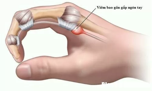 Bệnh ngón tay lò xo của dân văn phòng và cách phòng ngừa