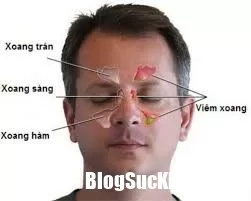Bạn sẽ chữa viêm xoang ngay hôm nay sau khi đọc xong 5 lý do này