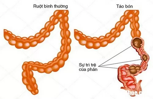 Những loại thuốc trị bệnh đường tiêu hóa lại có hại cho đường tiêu hóa