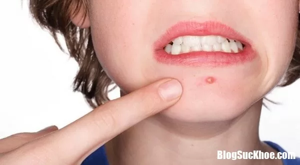 Những nguyên nhân gây ra mụn nhọt và cách xử trí