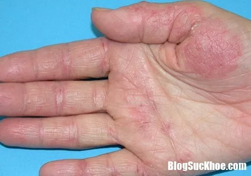 Cách phòng trị viêm da cơ địa hiệu quả