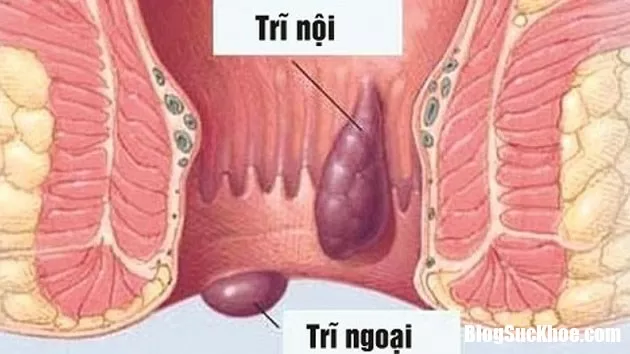 Những nguyên nhân phổ biến gây nên tình trạng đi ngoài ra máu