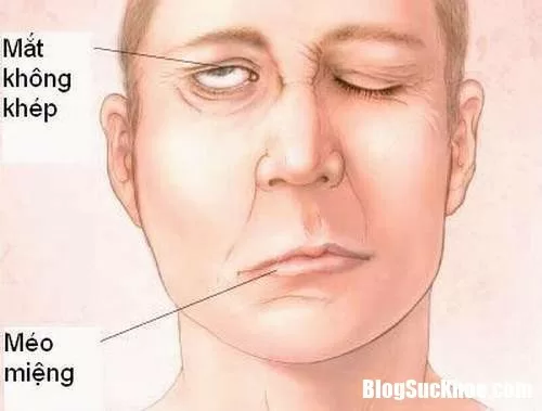 Những căn bệnh có dễ bị nhầm với đột quỵ não vì có chung dấu hiệu