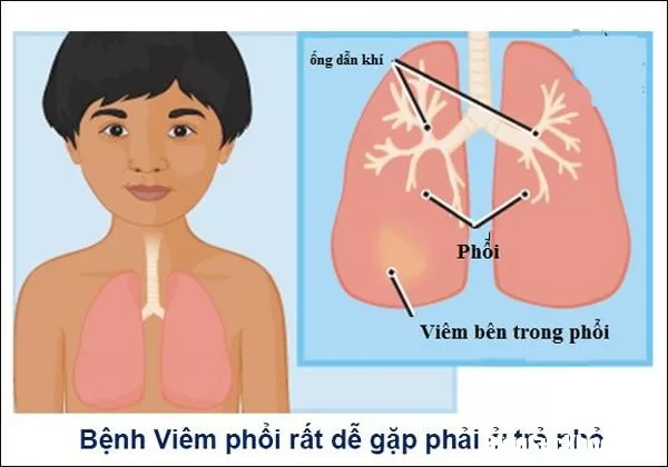 Viêm phổi ở trẻ và những điều cần lưu ý