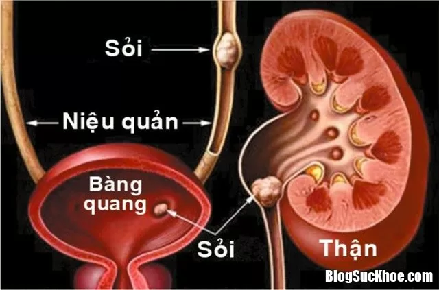 Sỏi niệu quản và những biến chứng sau mổ có thể gặp