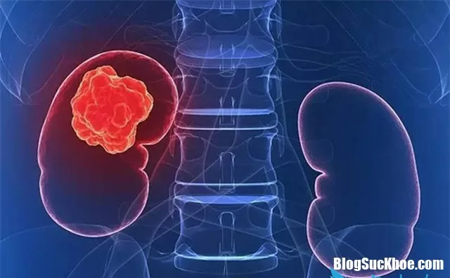 Những dấu hiệu nhận biết ung thư thận