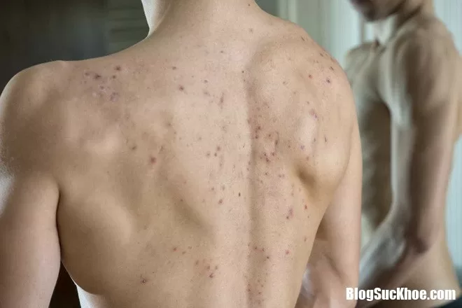 Mọc mụn trứng cá ở lưng có phải là bệnh không ?