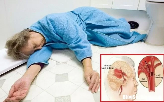 Những điều cần lưu ý đối với người bệnh sau đột quỵ