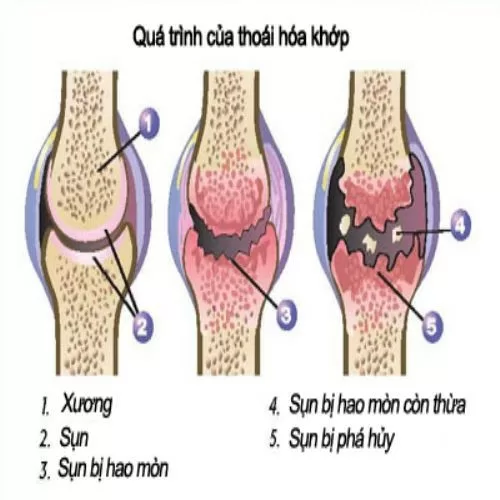 Những cách phòng ngừa thoái hóa khớp hiệu quả