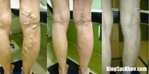 Cách dùng cà rốt và giấm táo chữa suy giãn tĩnh mạch