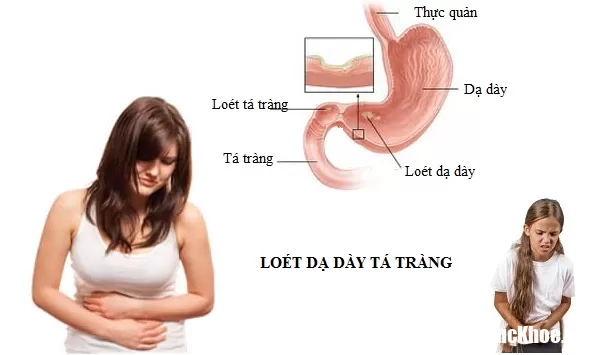 Cách phòng trị bệnh viêm loét bao tử hiệu quả nhất