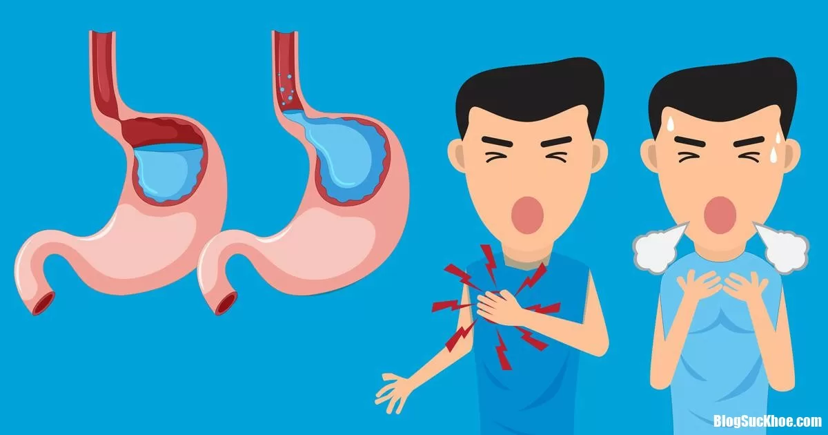 Trào ngược dạ dày ngày càng phổ biến