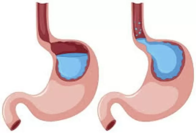 Trào ngược dạ dày - Căn bệnh nguy hiểm và ngày càng phổ biến
