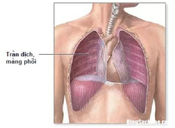 Triệu chứng tràn dịch màng phổi thường gặp nhất