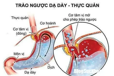 Những biểu hiện của bệnh trào ngược dạ dày
