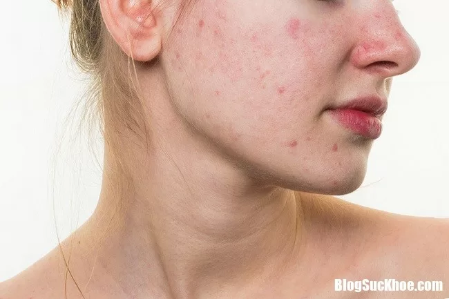 Những kiêng kỵ cần biết về dị ứng da