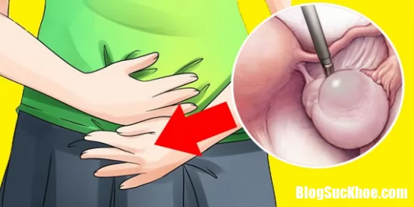 Cách chữa trị sớm bệnh u nang buồng trứng