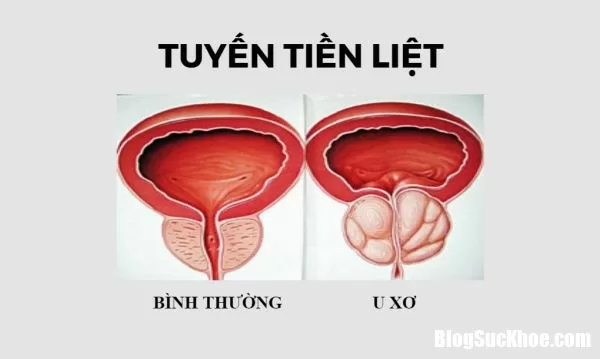 Những phiền toái do u xơ tiền liệt tuyến mang lại