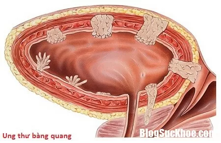 Cần phát hiện sớm bệnh ung thư bàng quang để chữa trị được hiệu quả