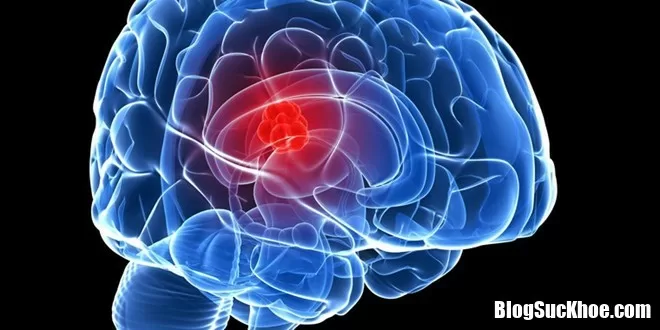 Biểu hiện, triệu chứng và cách phòng trị bệnh não