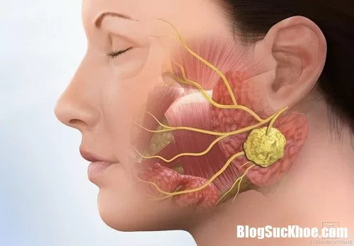 Những triệu chứng dễ nhận biết của ung thư vòm họng