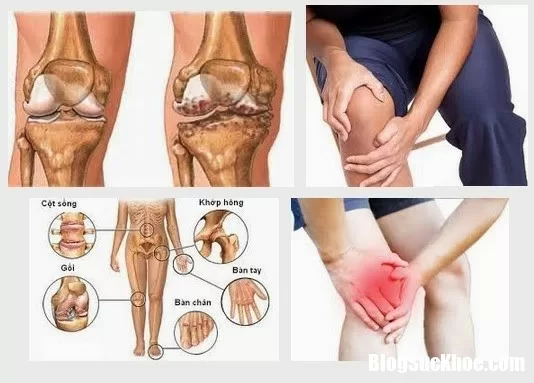 Những cách phòng bệnh đau mỏi xương khớp