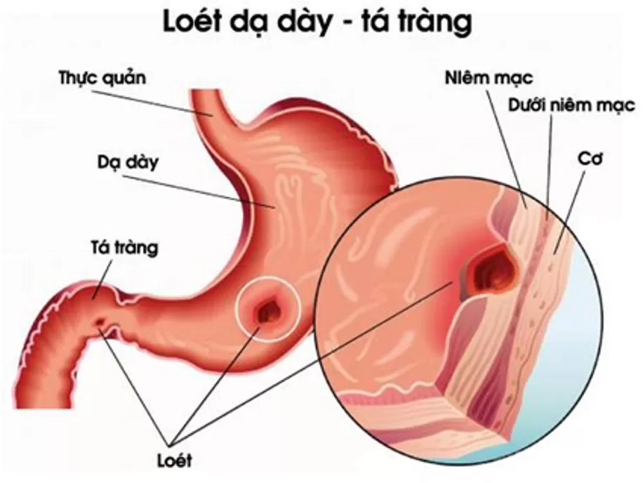Những triệu chứng báo hiệu bệnh viêm loét dạ dày
