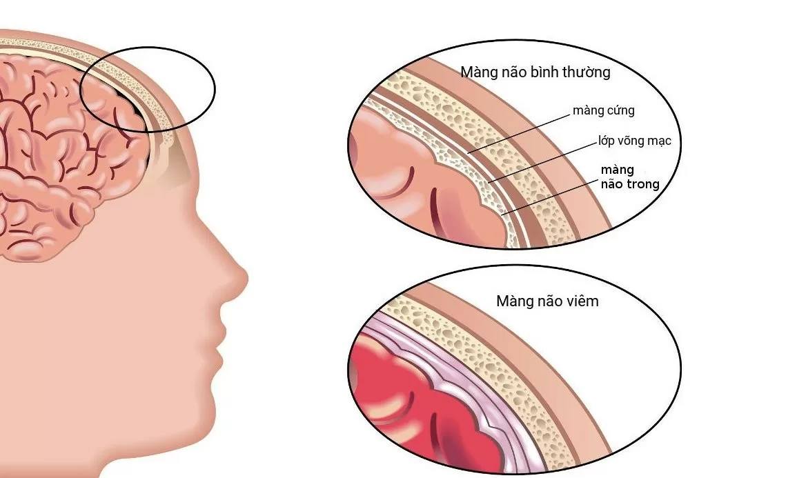 Bệnh thủy đậu và những biến chứng nguy hiểm cần đề phòng