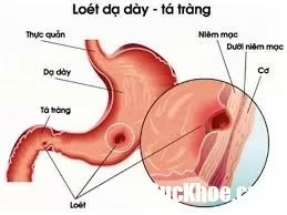 Bệnh loét dạ dày và những thông tin cần biết