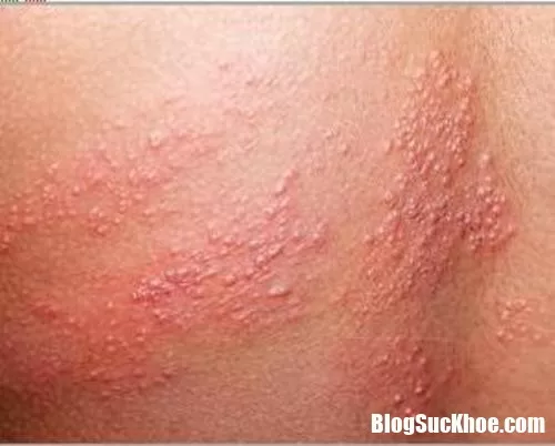 Bệnh zona là bệnh do vi-rút gây phát ban và đau đớn