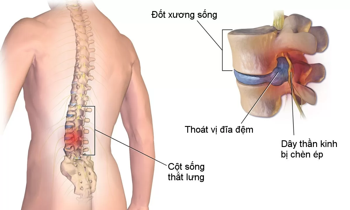 Cùng tìm hiểu nguyên nhân và cách phòng bệnh thoát vị đĩa đệm