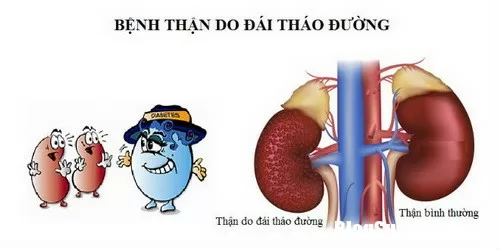 Vì sao người bệnh đái tháo đường thường mắc biến chứng thận ?