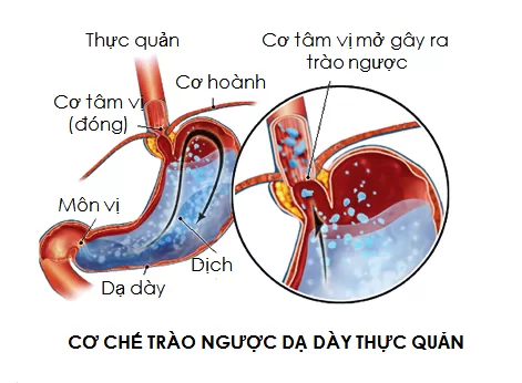 6 Cách chữa bệnh trào ngược dạ dày thực quản đơn giản, hiệu quả