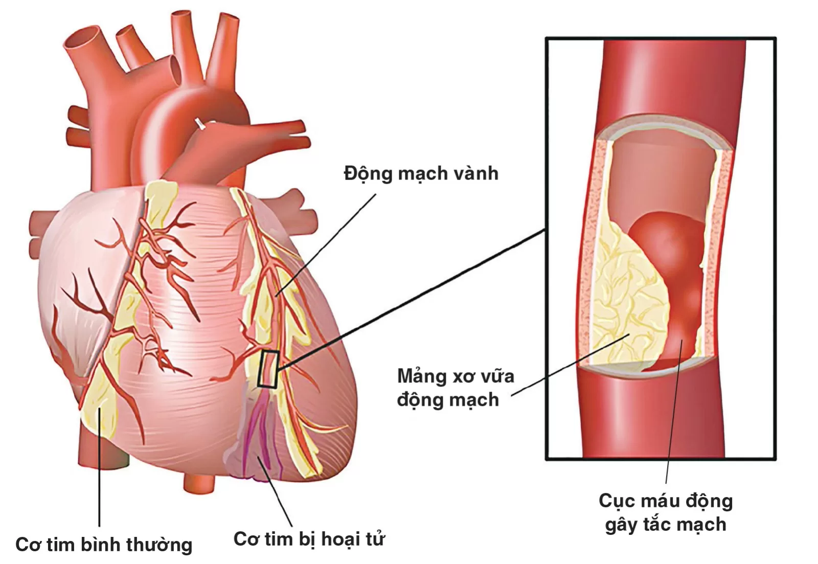 Nguyên nhân và triệu chứngư nhận biết bệnh động mạch vành