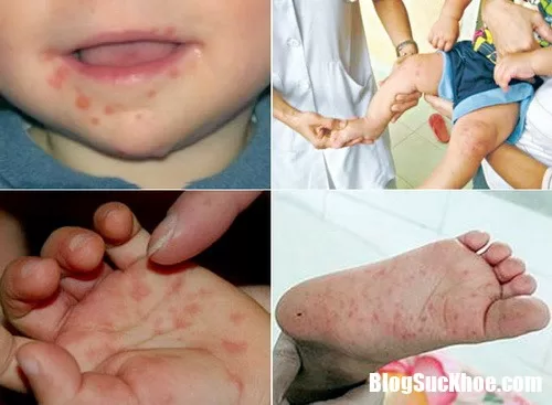 Cách nhận biết nhanh chóng bệnh tay chân miệng và biện pháp phòng tránh