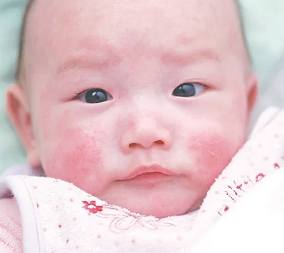 Những thực phẩm mẹ cho con bú không nên ăn khi bé bị chàm sữa