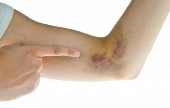 Những dấu hiệu thay đổi trên cơ thể báo bệnh ung thư máu
