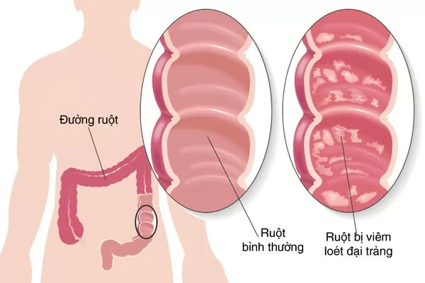 Cách nhận biết viêm đại tràng