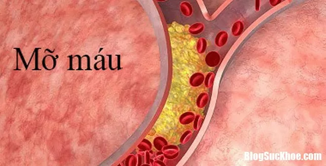 Bí quyết giảm mỡ máu hiệu quả