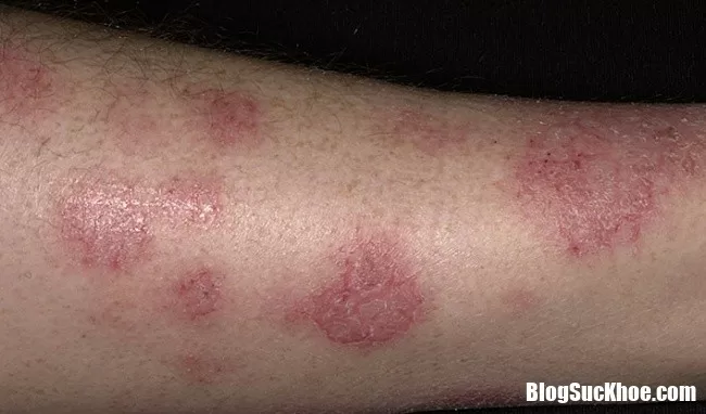Bị viêm da cơ địa phải làm sao để bệnh không trở nặng ?