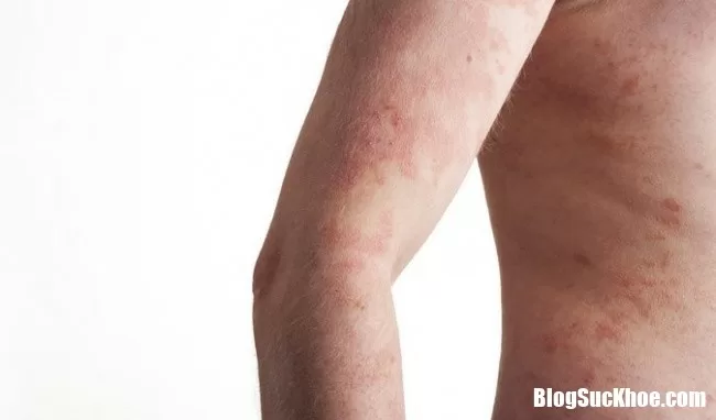 Khi bị eczema nhớ tránh những thực phẩm này