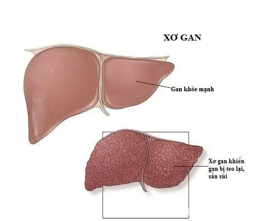 Xơ gan cổ trướng là gì ? Có nguy hiểm không ?