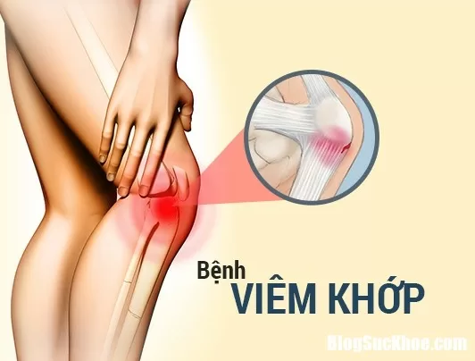 Những cách điều trị bệnh viêm khớp hiệu quả nhất